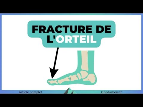 Orteil cassé : comment savoir, comment soigner ?