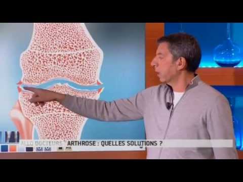 Qu'est-ce que l'arthrose ? - Allô Docteurs